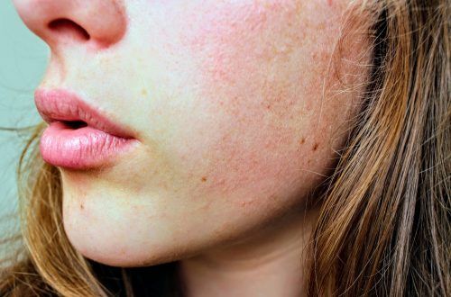 chica con rosácea en la piel del rostro
