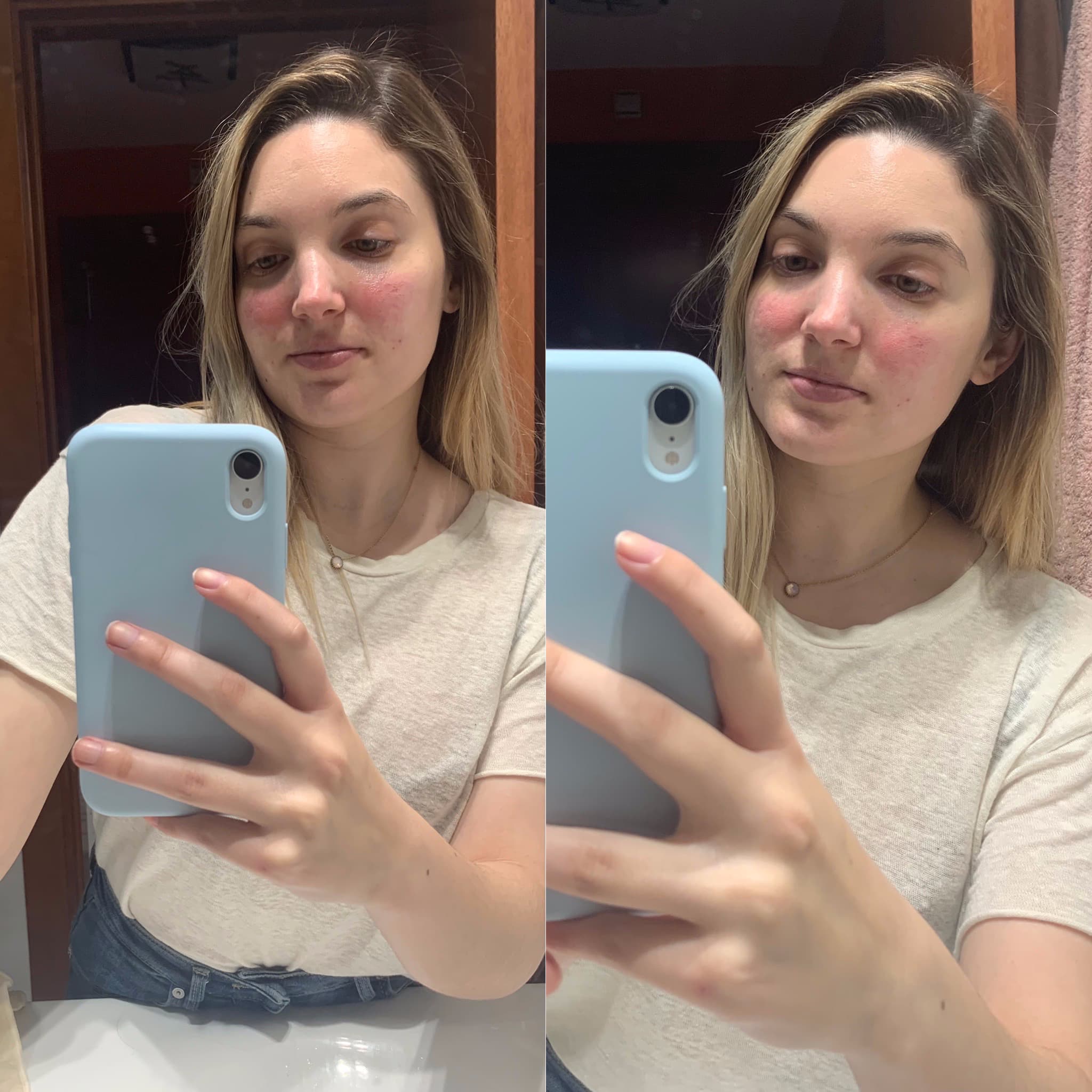 Mi experiencia con el IPL para rosácea - Mi Rosácea