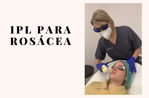 Experiencia IPL rosácea